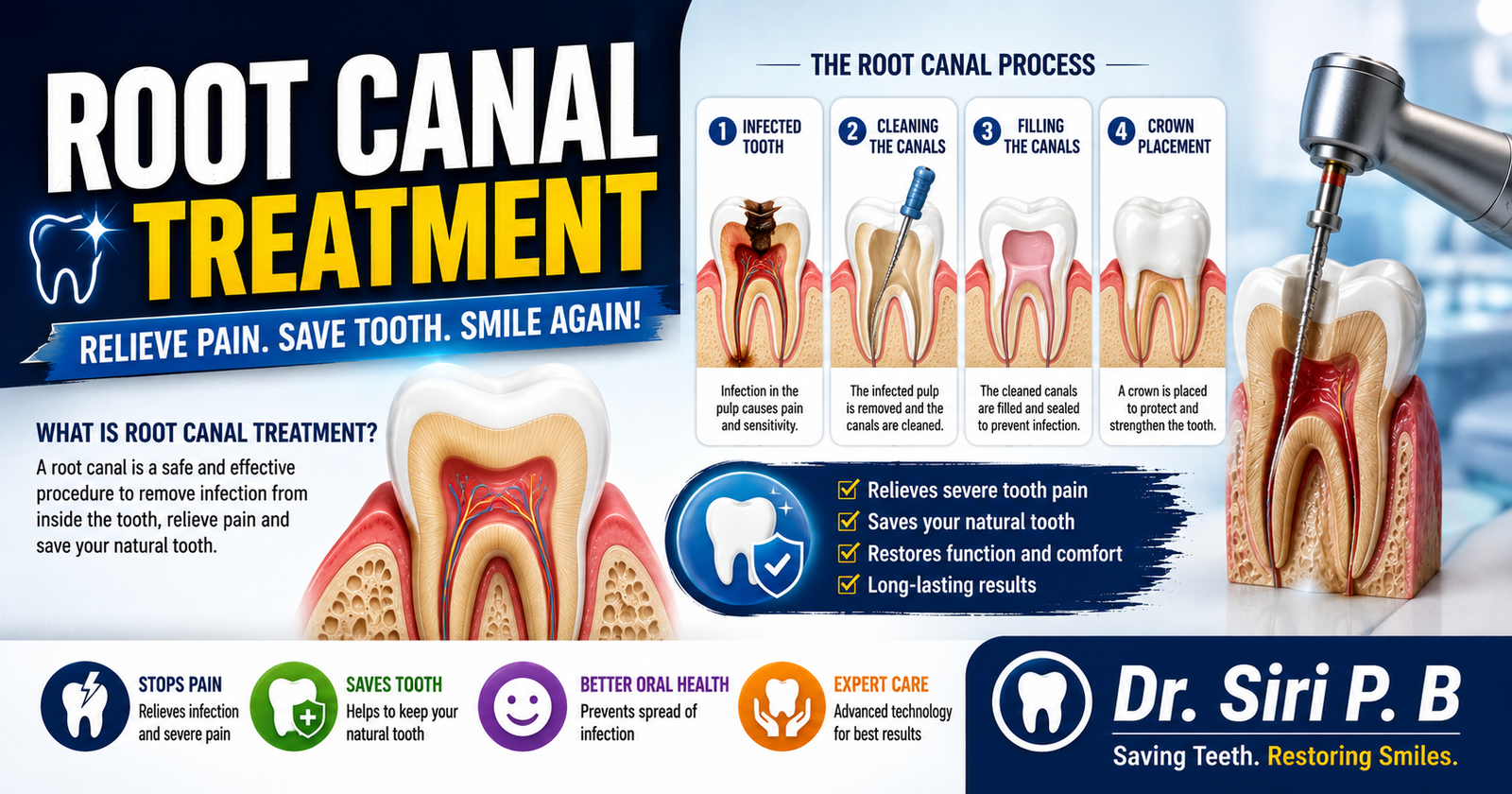Root Canal Treatment